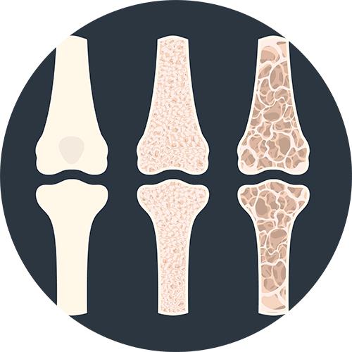 Illustratie van drie botdoorsneden die afnemende botdichtheid tonen: gezond bot, osteopenie en osteoporose.